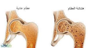 صورة توضيحية لهشاشة العظام